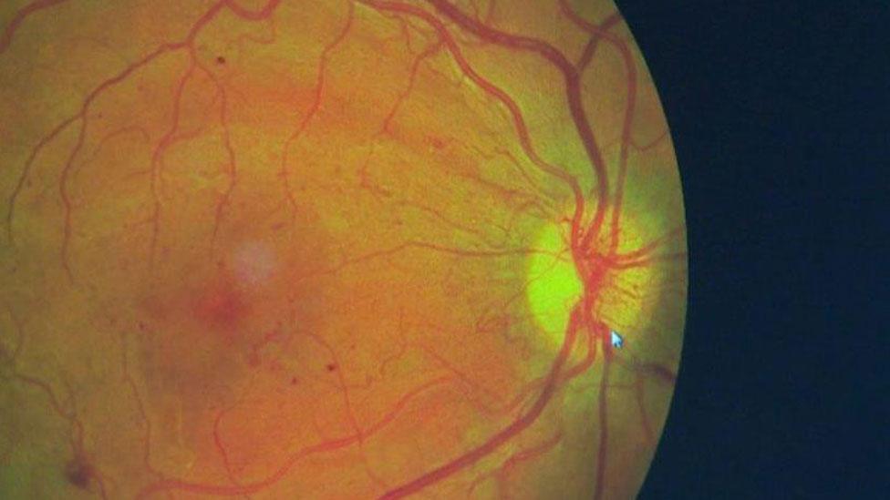 Damaged retina