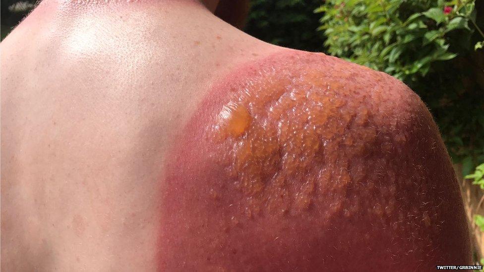 Greg Binnie shows off his burns from heat wave