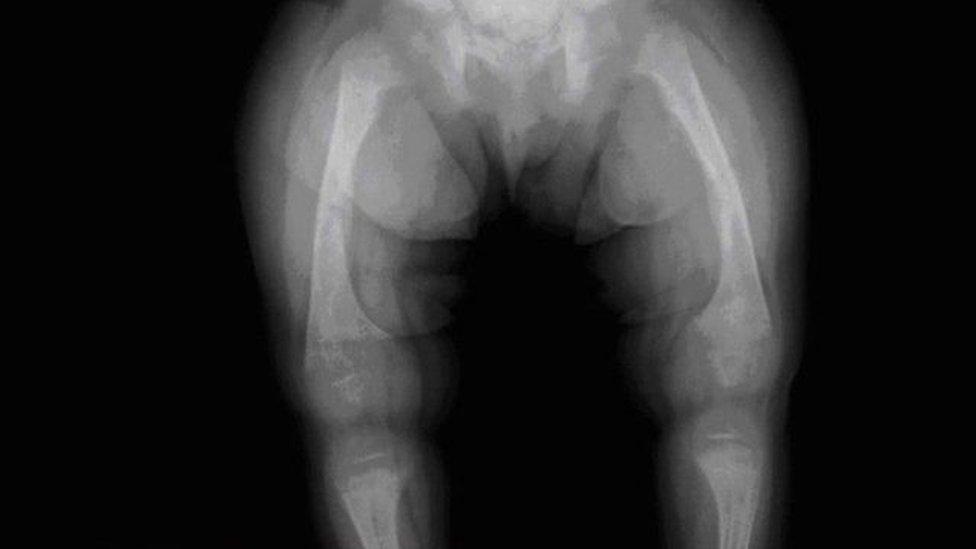 X-ray of child with rickets