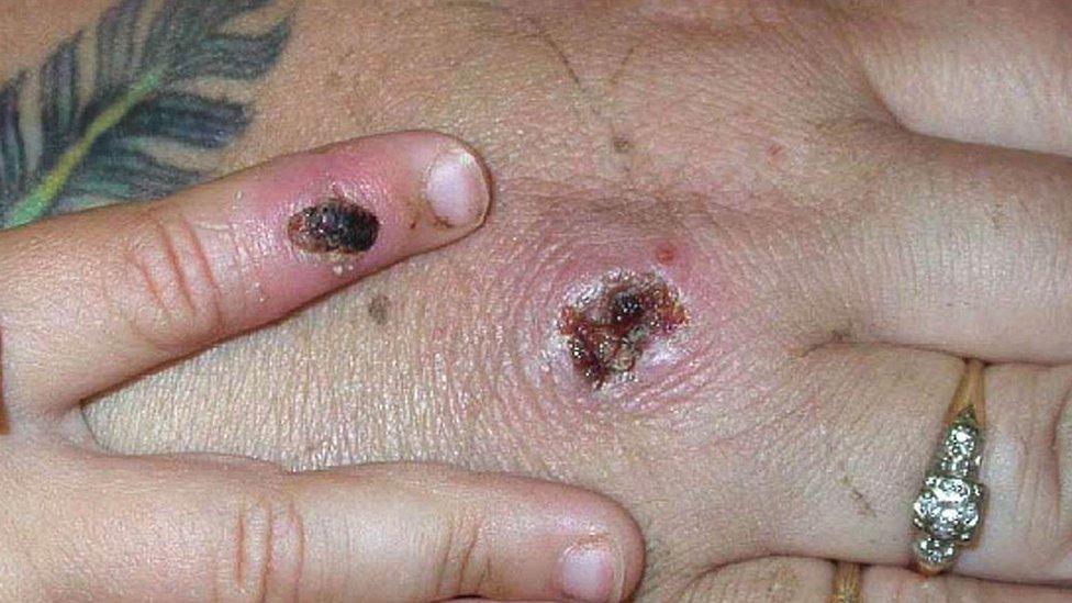 Scabs on a person's hands from monkey pox