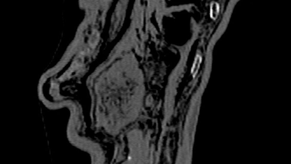 X-ray imaging of the Iceman’s stomach and intestine