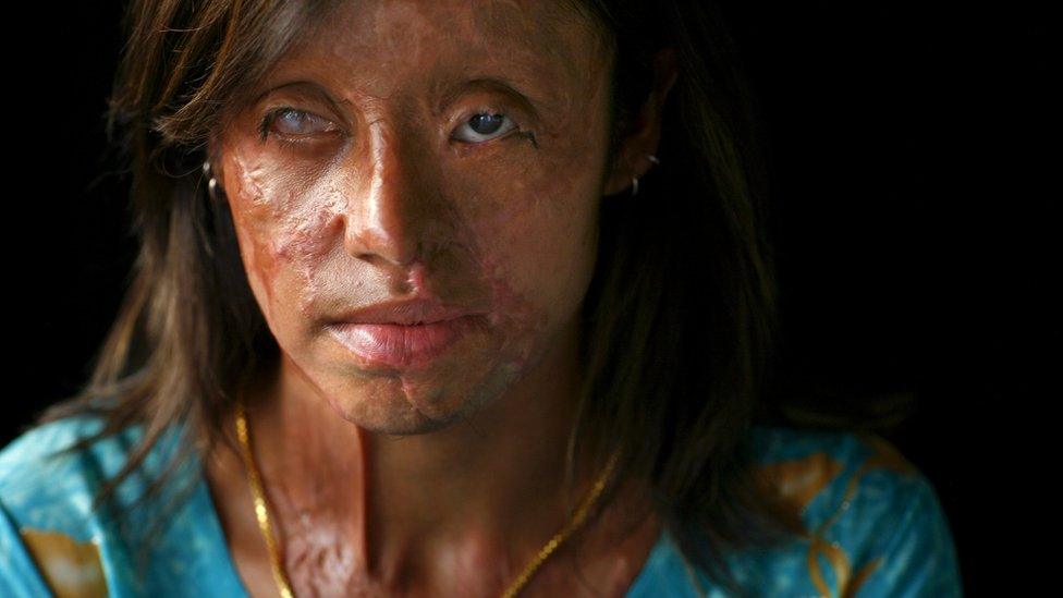 Saira Liaqat, 22, a victim of acid violence who was burned 4 years ago, poses in Islamabad, June 11, 2007