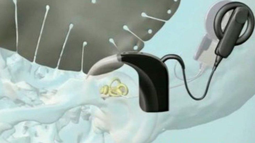 Cochlear implant