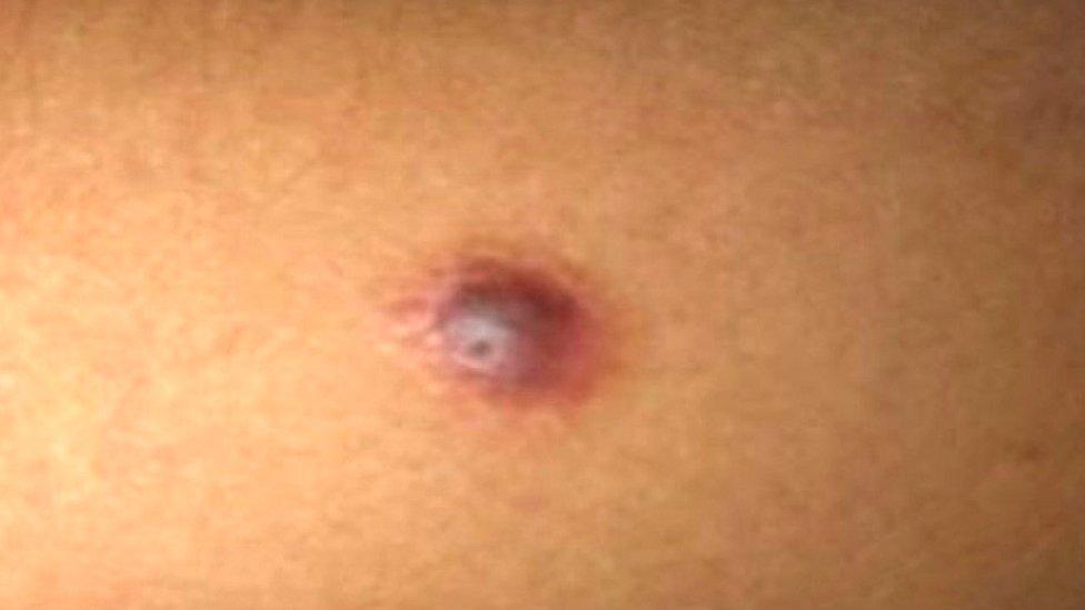 Kass's melanoma