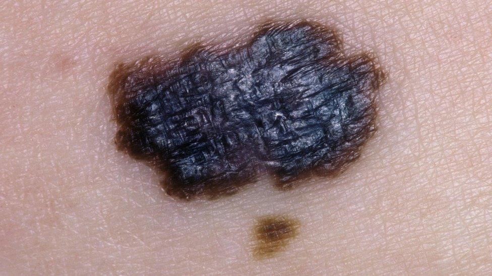 Skin cancer