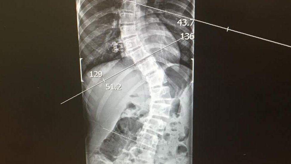 X-ray of spine