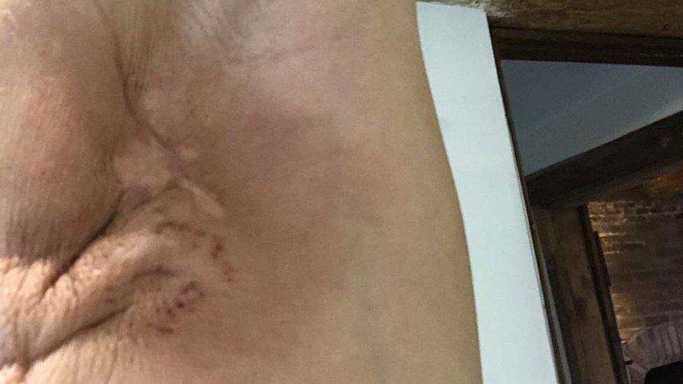 Armpit post-surgery