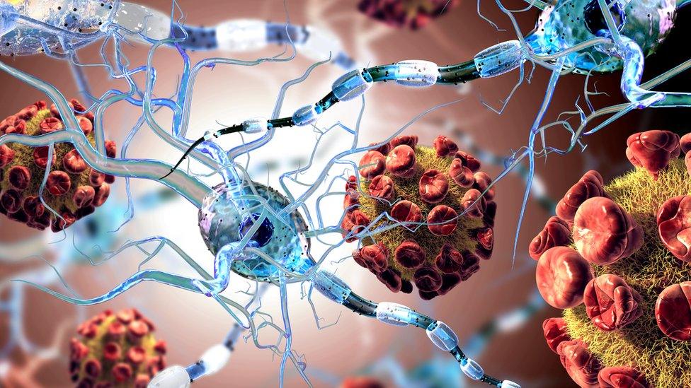 Nerve connections damaged in MS