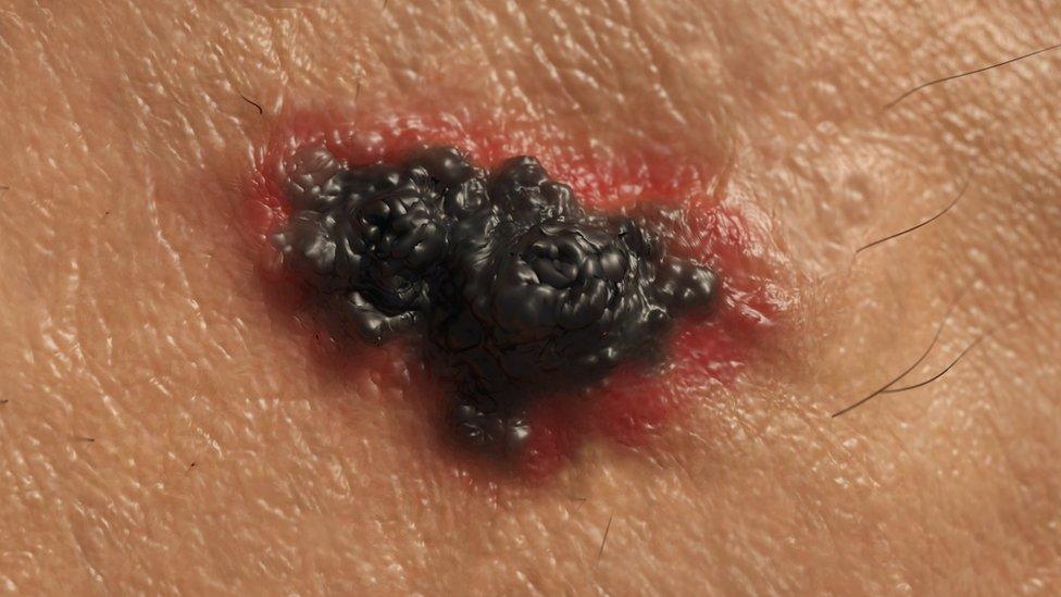 Melanoma