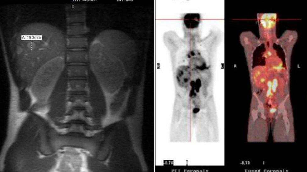 Duncan DeLoach's MRI and PET scans, both showing metastasized cancer