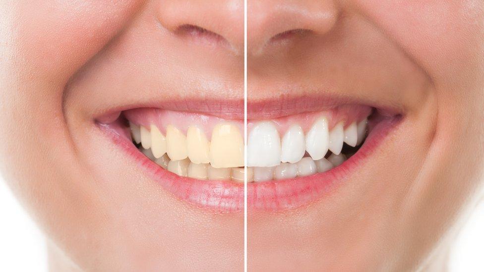 Before and after whitening picture of teeth