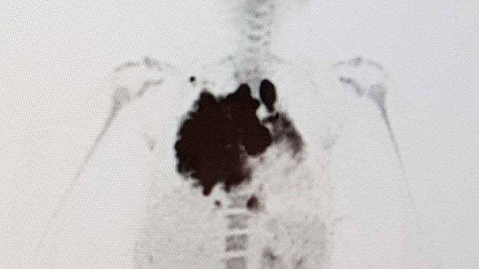 A scan showing the large mass found in Kathryn's chest