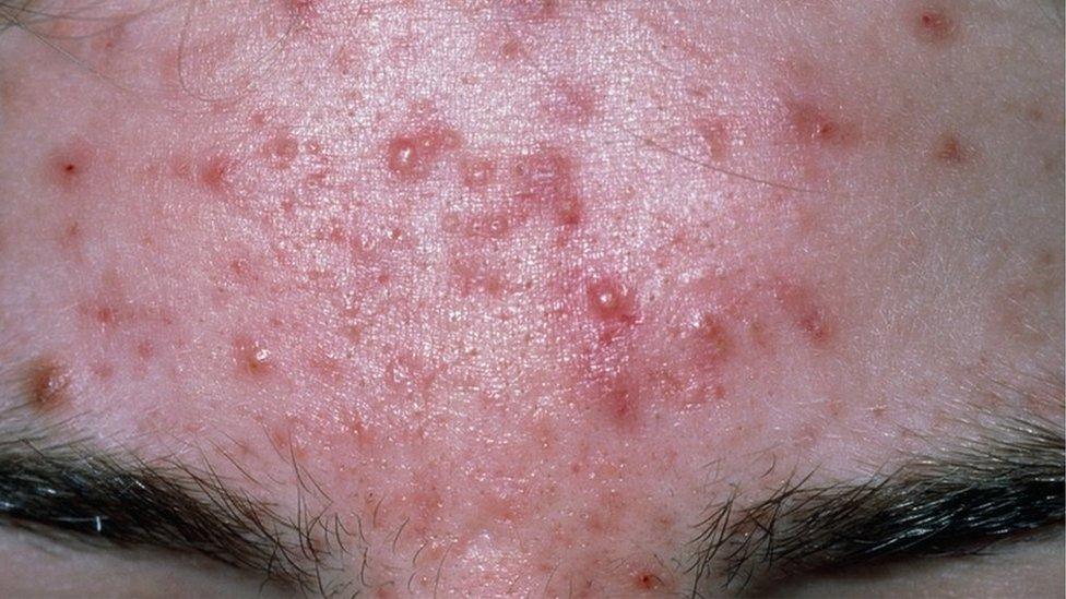 Acne on a person's forehead