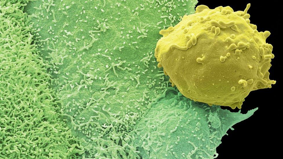 Prostate cancer cell