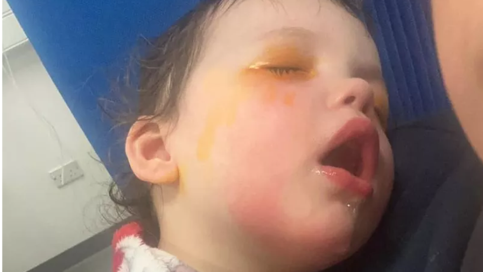 Child leaning back with closed eyes. There are yellow stains around the eye area