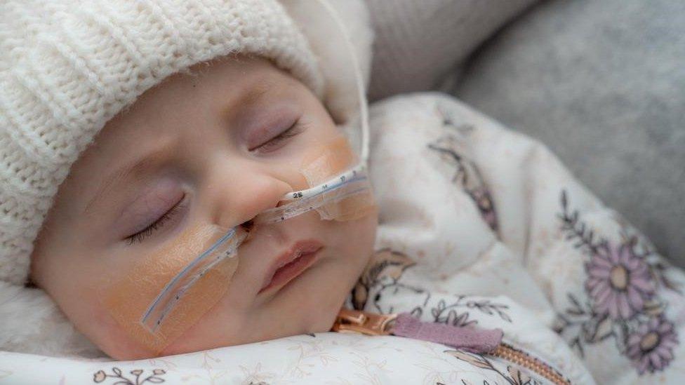 A sleeping baby with a feeding tube in her nose