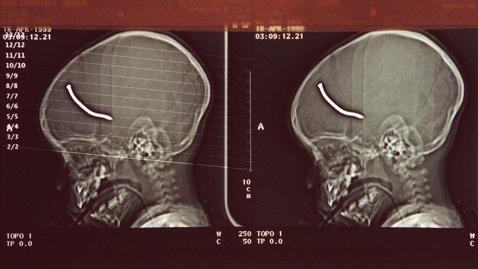 X-ray of boy's injuries