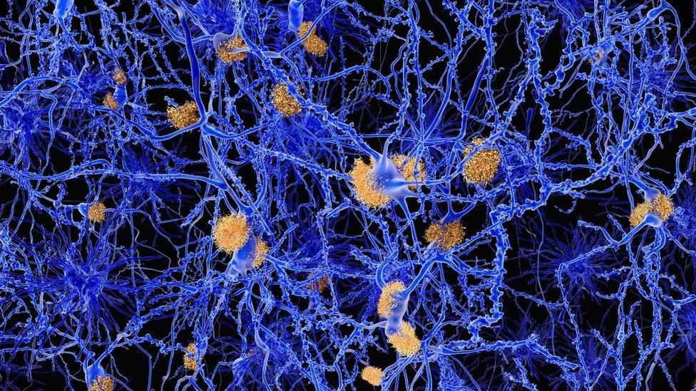 Alzheimer's plaques