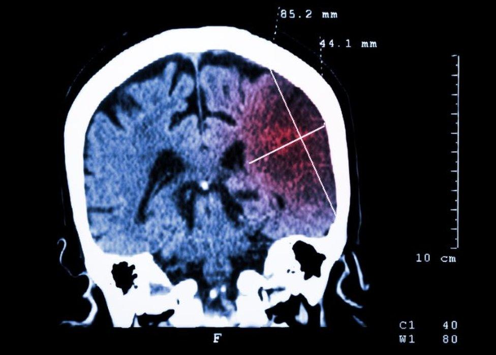 CT scan of brain and stroke