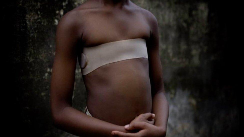 A girl with strap around her chest following breast ironing