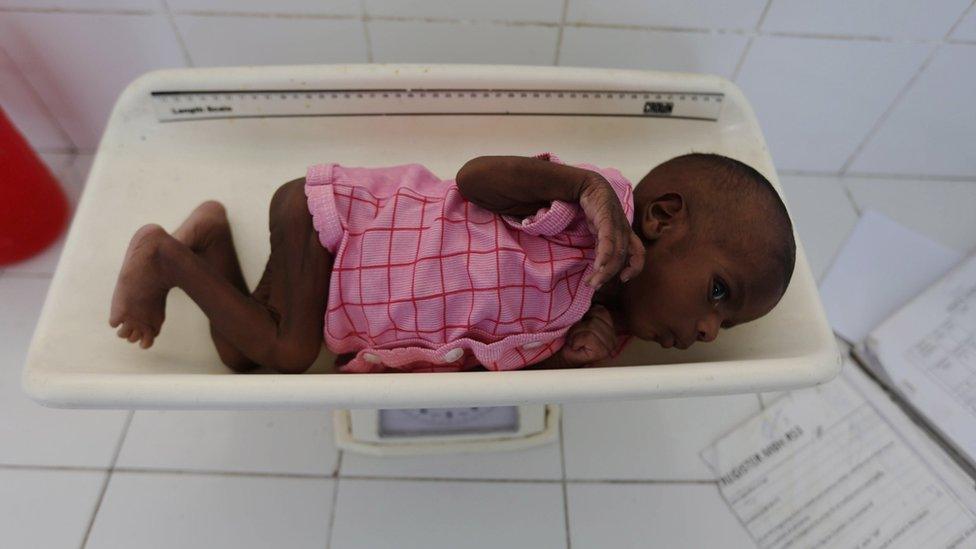 An internally displaced Somali child is screened for malnutrition before receiving treatment inside a ward dedicated for diarrhoea patients at the Banadir hospital in Somalia"s capital Mogadishu