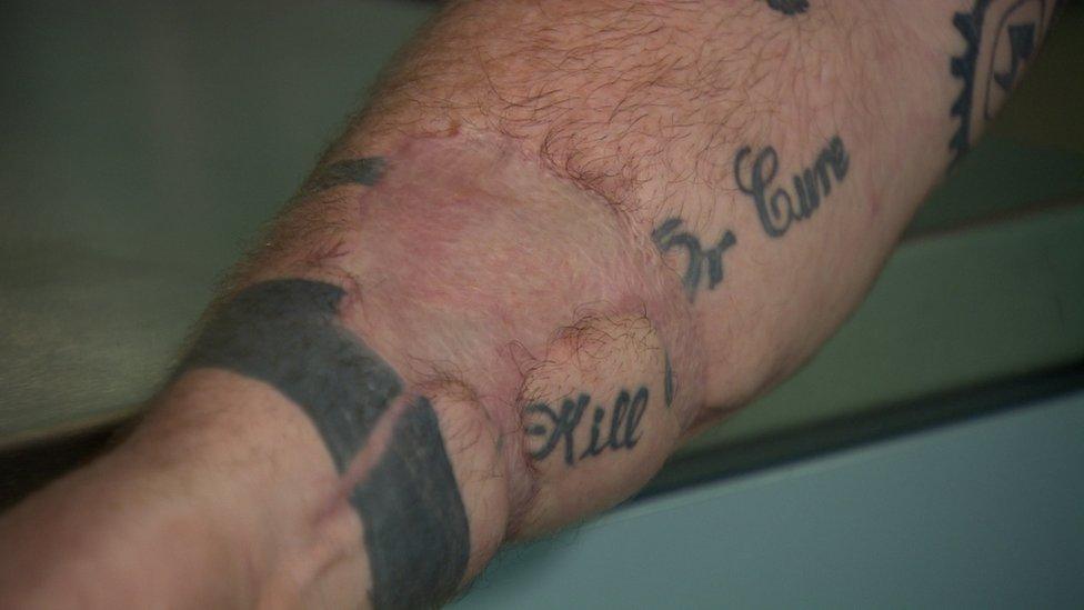 Scars on Steven Cull's arm