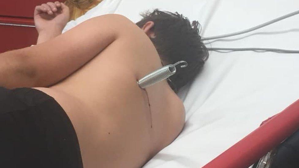 Boy with metal coil spring in his back