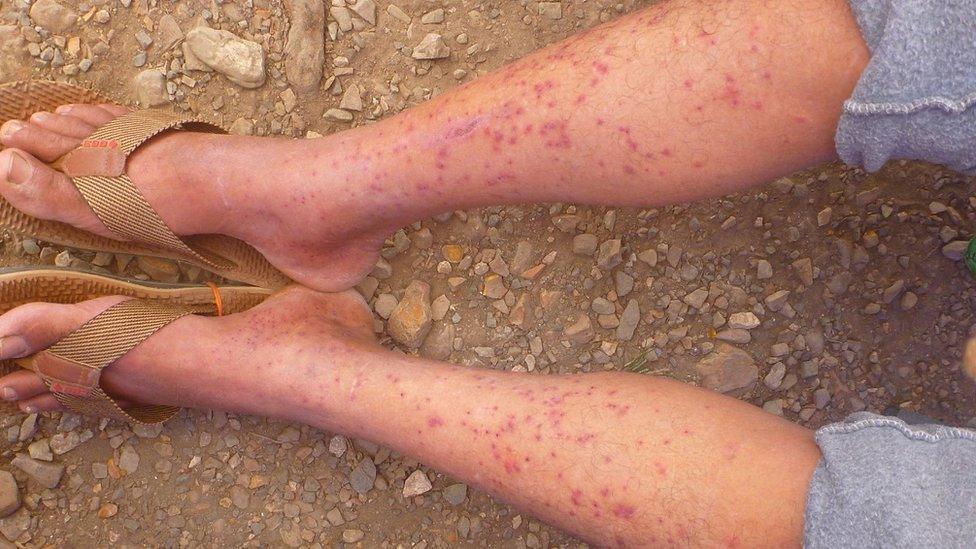 A patient with cercarial dermatitis