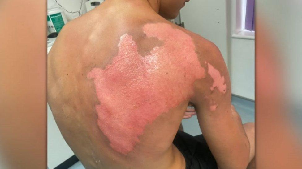 Alfie's back, covered in pink burns