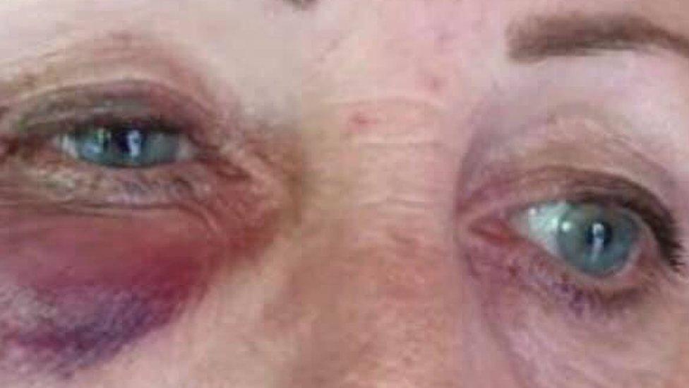 Bruised eyes
