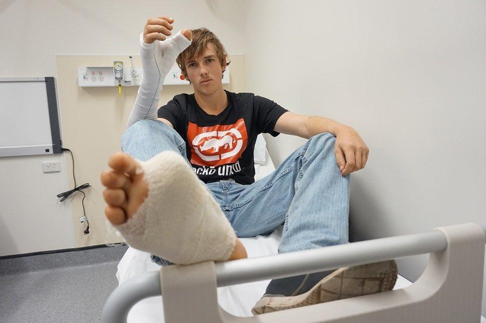 Zac Mitchell with bandages on his right hand and foot