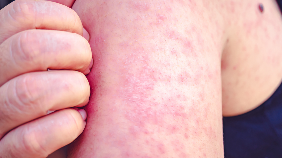 A woman with a rash caused by measles