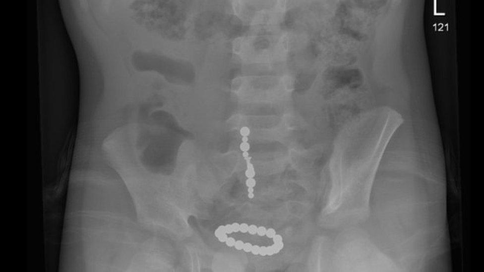 X ray showing magnets in child's intestine