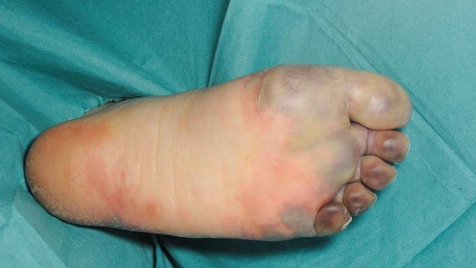 Heather Duncan's blackened feet from septic shock