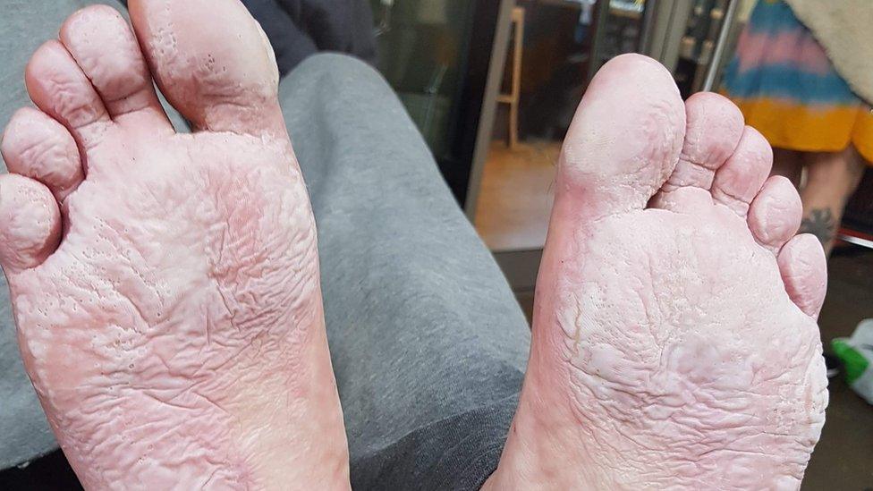 A homeless person's badly sodden feet