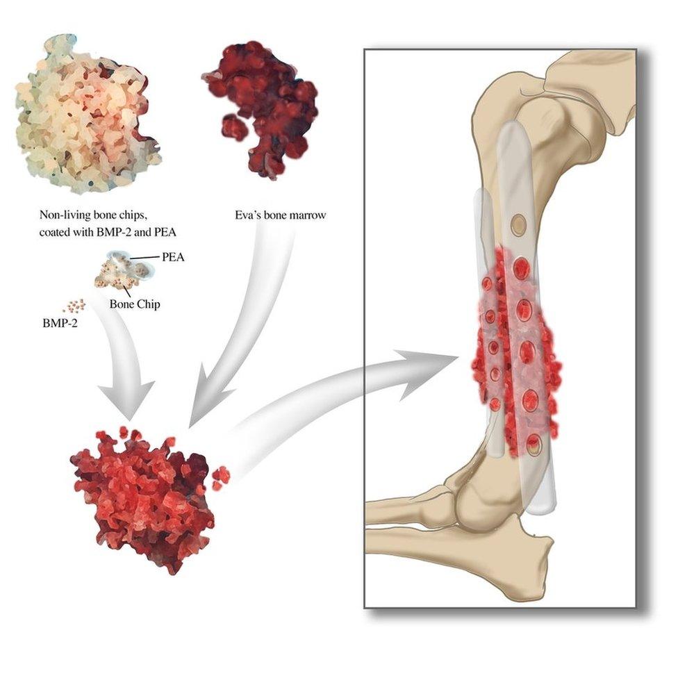 Bone growth graphic