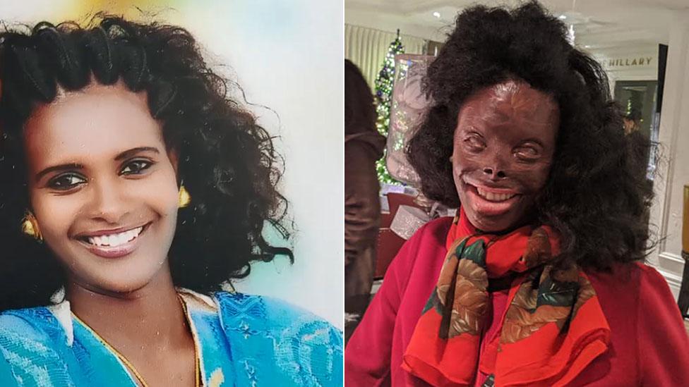 Atsede Nguse suffered major acid burns in attack by her husband