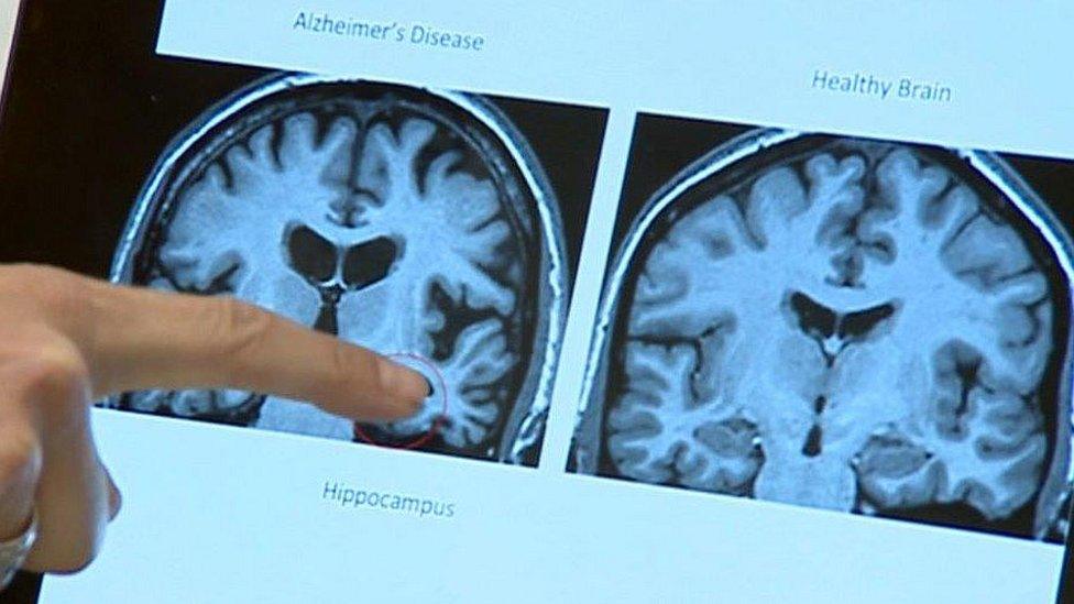 Scans of a brain with Alzheimer's (left) and a healthy brain