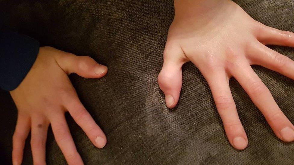 Boys' swollen thumbs