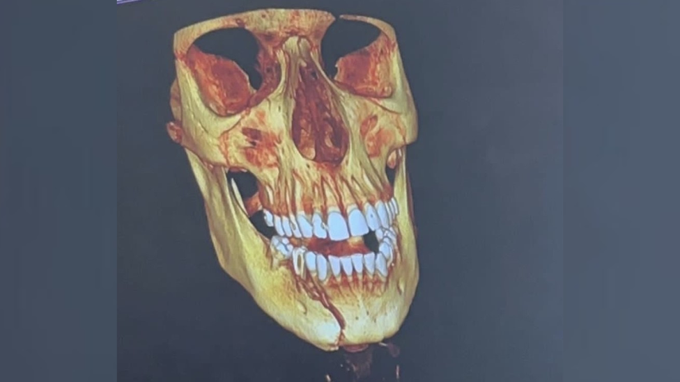 A scan showing Callum’s broken cheek and chin after the accident