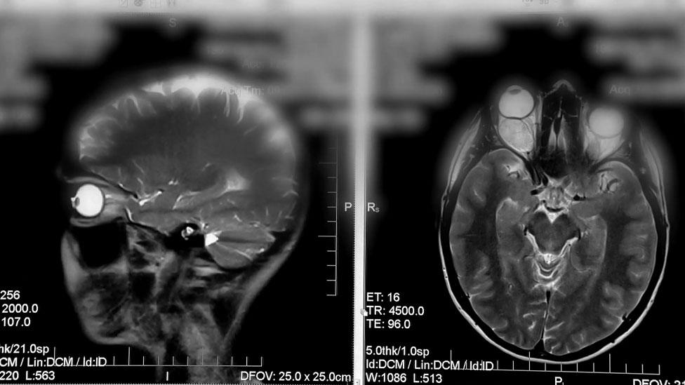 Brain scan of Jules Rose