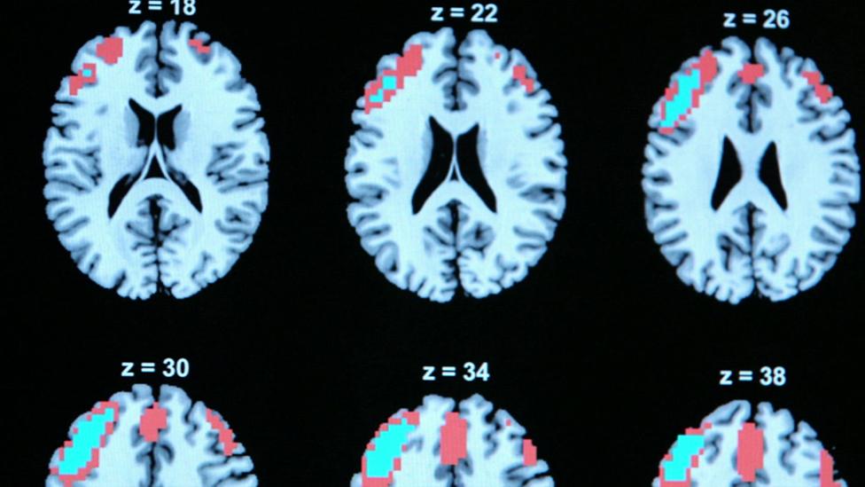 neural images showing brain activity