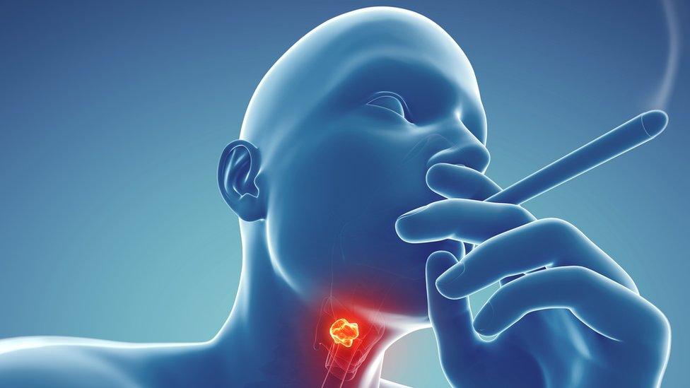 can tobacco cause sore throat Persistent sore throat 'can be cancer sign'