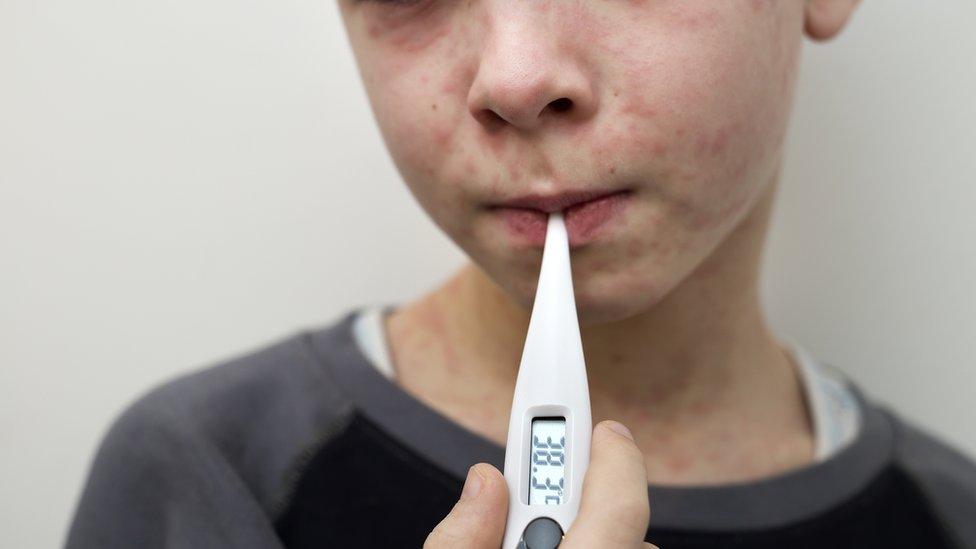 A boy with a measles rash taking his temperature