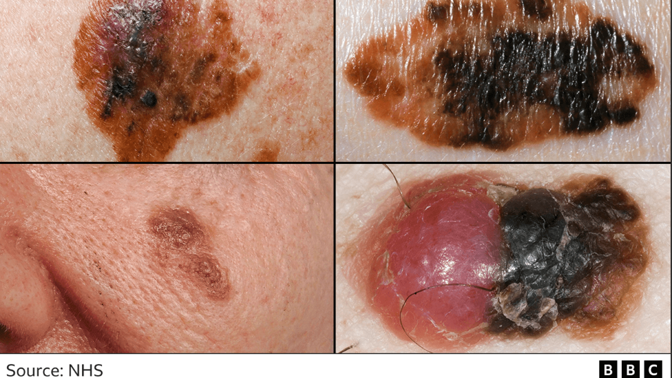 Melanoma pictures