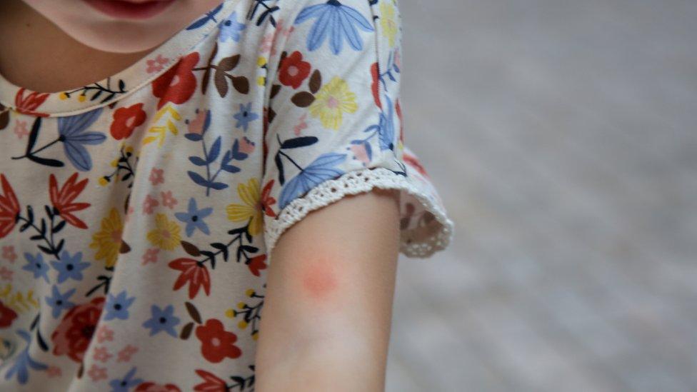 girl with mosquito bite