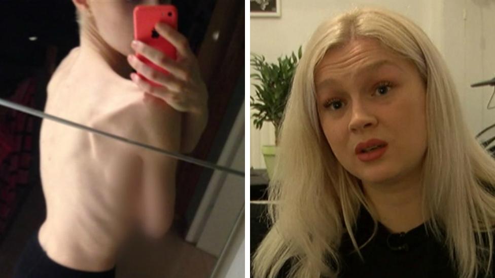 (L-R) Alex Young at 17, when she bought diet pills on social media, and now at 22