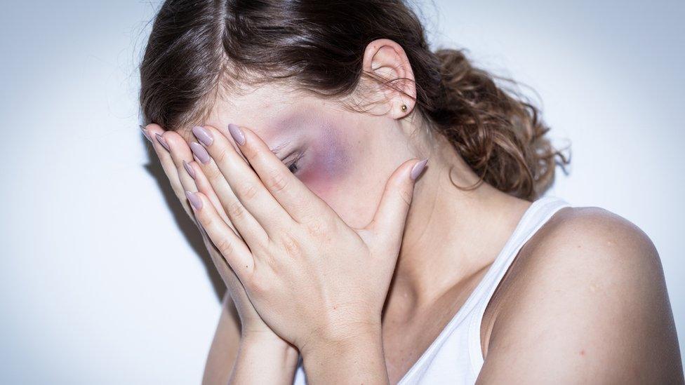 A woman with a bruised face