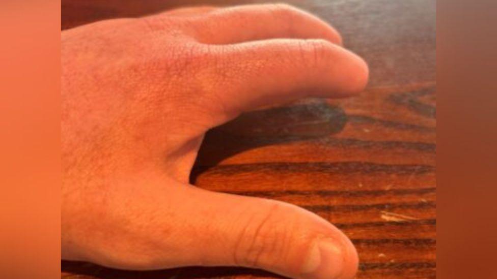 Tom Matthews' hand after the injury