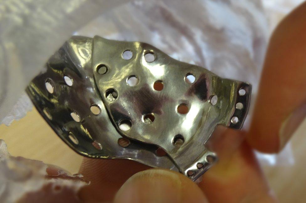 A 3D printed implant for a fractured eye socket